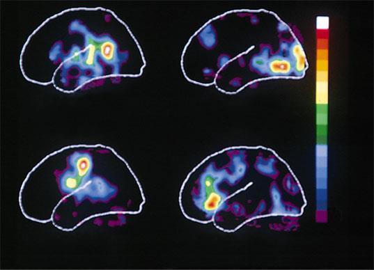 Mapping language areas in the cerebral cortex Max
