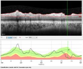OCT Imaging OCT Imaging The circumpapillary retinal nerve fiber layer (RNFL) thickness profile shows a double hump pattern, with its peak in the superior and inferior quadrants Glaucoma is