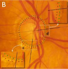 A new method for documentation of optic nerve & peripapillary anatomical structure Burgoyne, Chauhan, & colleagues reminded us all that 3-D is better than 2-D The clinically perceived disc margin is