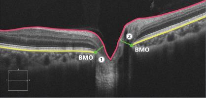 (Ophthalmology APR2012) Minimal Rim Width New Metric to Assess Optic Disc BMO-MRW (minimum rim width based upon BM opening) quantifies the neuroretinal rim from a true anatomical outer border.