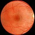 for glaucoma damage is: High variability of the ONH size and shape Even among healthy individuals Wide range of optic cup shapes and sizes Variable size and configuration of blood vessels Variable
