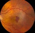 Wet AMD: Anti-VEGF Therapy Retinal thickness map Retinal thickness RPE segmentation ILM segmentation RPE segmentation RPE segmentation VA: 20/40 Anti-VEGF Therapy: 1 month