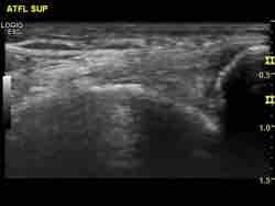 Anterior Talofibular ligament Frequently comprises superior and