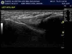 tendons Tense in Crosses subtalar joint Isolated rupture very