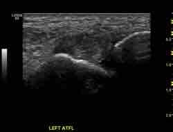 Instability Further ligament injury Impingement Hypertrophy of soft tissues Impingement * Lat Lat Lateral
