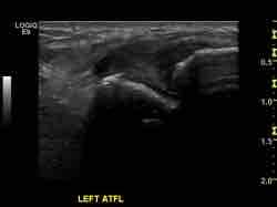 Anterior syndesmotic ligament easily evaluated Associated LCL injury Posterior may need MRI Deltoid visualised,