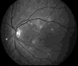 age-related macular