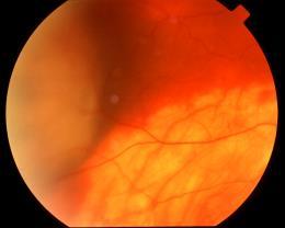 Ocular Trauma: Choroidal Haemorrhage Iris, Ciliary Body Trauma 13 14 Choroidal