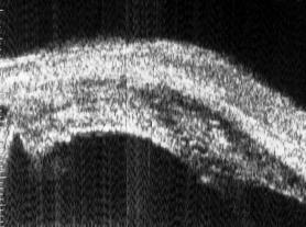 UBM image showing choroidal effusion with no ciliary body detachment at 6-o clock