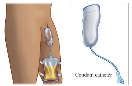 Sampling from a condom catheter Ideal = remove condom, cleanse peri-urethral area then collect MSU Second best = remove