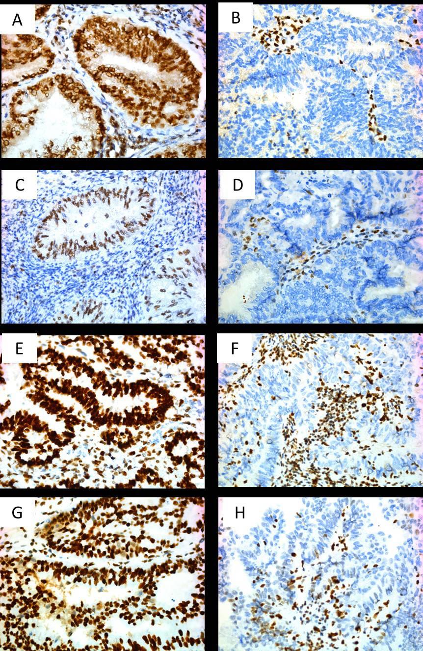 ICH and Molecular characterization of endometrial cancer samples. A series of 46 ECs were analysed for MMR protein expression by IHC.
