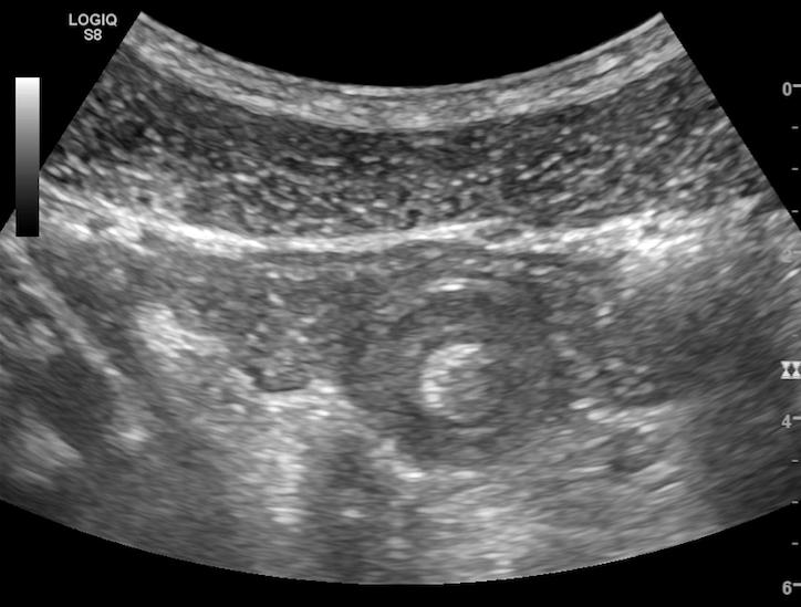 9. Mehta RS. Jejunal intussusception as an unusual cause of abdominal pain in an adult. Mcgill J Med 2009;12:28-30. 10.