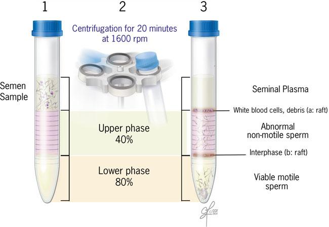 14 Sperm Preparation for Intrauterine Insemination Using Density Gradient Separation 103 3. Measure the total semen volume using a sterile 2 ml serological pipette. 4.