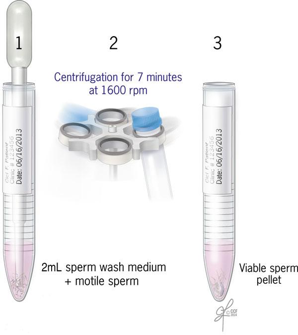 104 A. Agarwal et al. Fig. 14.3 HTF resuspended sample centrifuged to produce viable sperm pellet [Reprinted with permission, Cleveland Clinic Center for Medical Art & Photography 2015.