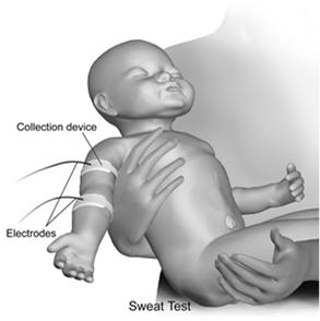 when infant is 3 4 weeks old (> 2 kg) Sweat is collected for 30 minutes Sweat chloride concentration is quantified STEP THREE Sweat test and appointment with Genetic counselor Positive Sweat test