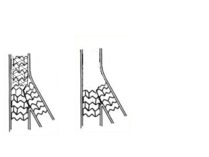 Various Techniques for Stenting Bifurcation Lesions Bifurcation Lesion Stent+PTCA Stent+stent ( T stenting ) Stent+stent ( reverse-t ) Main vessel