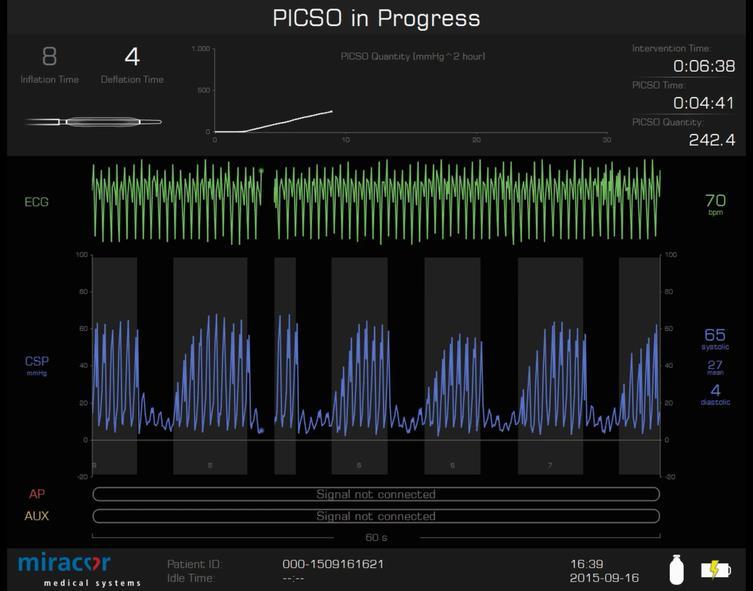 PiCSO system in Progress Intermittent occlusion of the CS (min. 3 sec., max. 30sec.