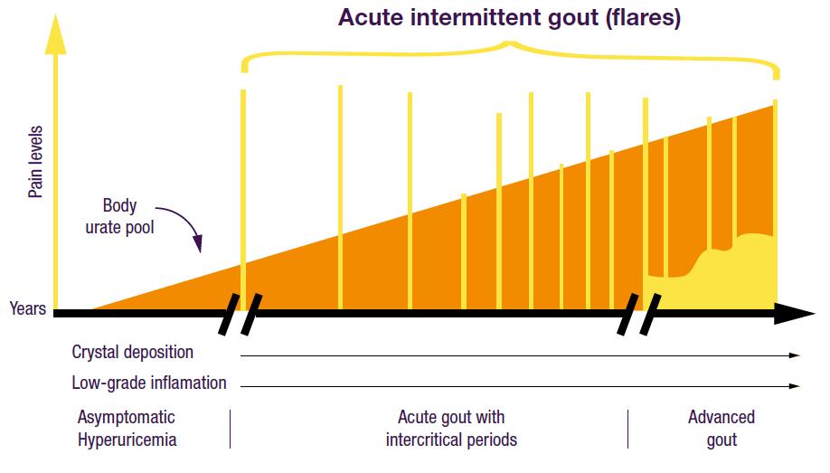 Gout: A Progressive Condition Gout is the most common form of inflammatory arthritis, estimated to affect 8.3 million (3.9%) Americans. Adapted from Edwards NL. Gout. A. Clinical features.