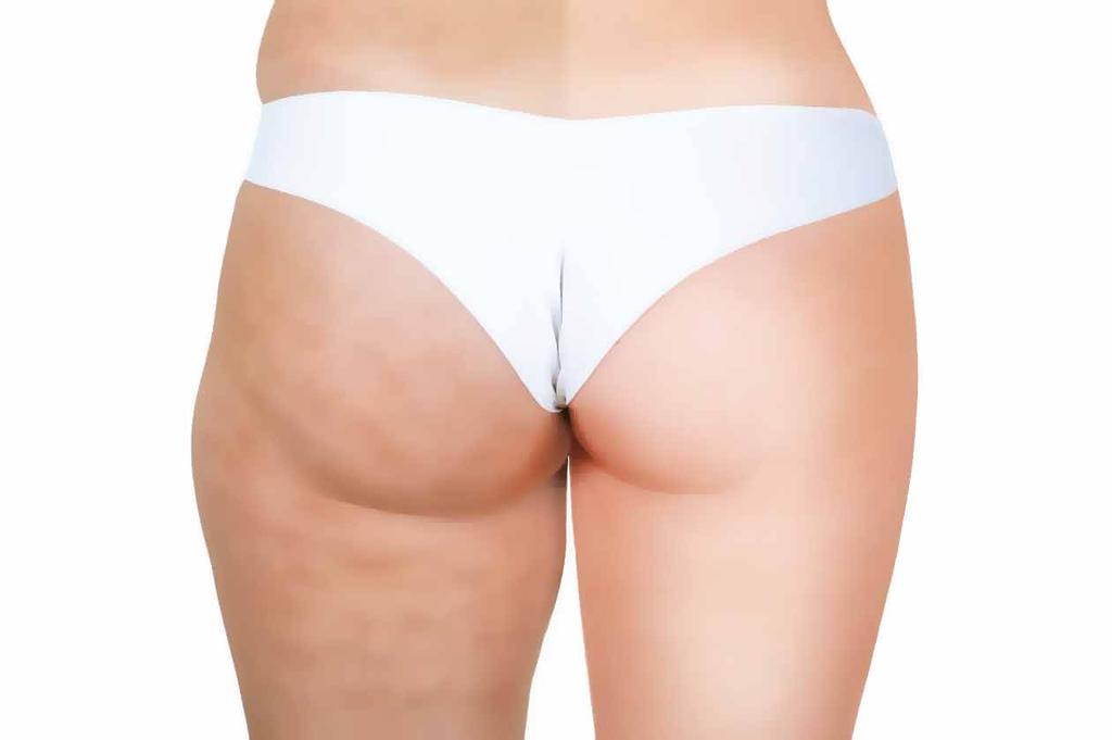 5 Procedures for cellulite An additional option that some people who are serious about getting rid of their cellulite, and who are battling much larger degrees of cellulite, are considering are the