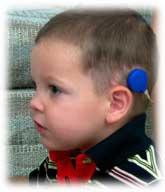 of hearing loss: bilateral severe to profound No medical contraindications