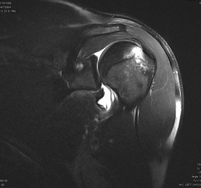 Fig.1. MR arthrogram shoulder. Coronal T1 fat-saturated study shows avulsion of the inferior glenohumeral ligament from the attachment onto the humerus (arrow).