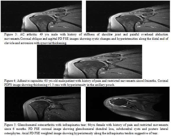 Chaudhary H, Aneja S. MRI Evaluation of Shoulder Joint: Normal Anatomy & Pathological Finding A Pictorial Essay And Review. IOSR Journal of Dental and Medical Sciences (JDMS) Volume 2, Issue 2 (Nov.