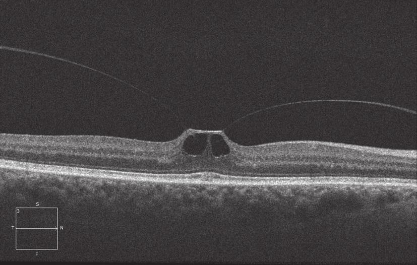 the macula over time.