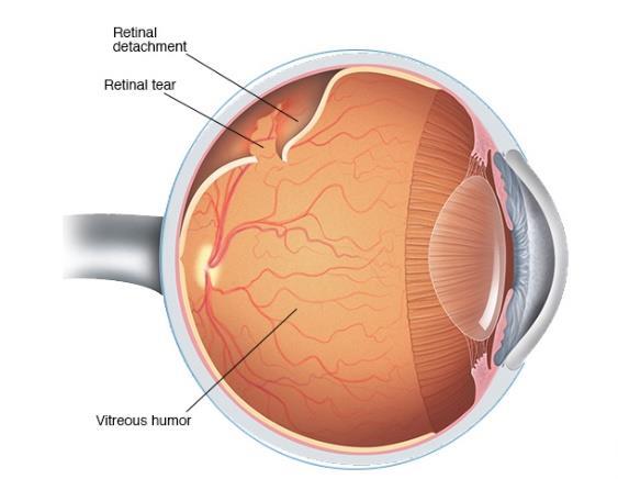 Retinal detachment Retinal detachment describes an emergency situation in which a thin layer of tissue (the retina) at the back of the eye pulls away from its normal position.