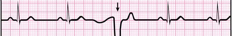 ECGs, Abnormal Extrasystole : note inverted QRS