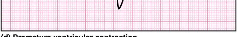 Extrasystole : note inverted QRS complex,