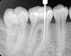 Introductions Clinical Endodontology was recently dominated by plenty of technical developments related to new equipment, modern tools and materials and innovative techniques in order to provide more