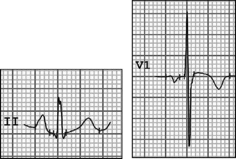 Atrial Abnormalities 1. RAA >2.5 mm in any lead 2.