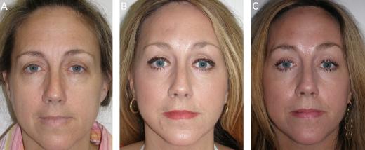 SUBCUTANEOUS BROW- AND FOREHEAD-LIFT Figure 11. This patient is shown before (A), 6 months postoperatively (including lower bleph and periorbital CO 2 laser; B), and 1 year postoperatively (C).