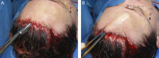 Avoiding lateral extension past the temporal crest produces less swelling and frontal nerve intrusion. A small downward extension of the excision will prevent a dog-ear at the incision terminus.