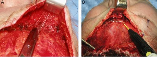 As with any fragile lipocutaneous flap, underlying hemostasis is a requisite as postoperative hematoma formation could devitalize the flap. Addressing the Brow Depressors Figure 5.