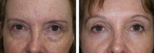 NIAMTU Figure 9. This patient is shown before and 6 months after subcutaneous open brow lift. She also had simultaneous upper and lower blepharoplasty.