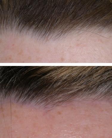 No patients complained about the resultant postsurgical scar, extended paresthesia, or need to alter their hairstyle.