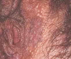 Vulvar Intraepithelial Neoplasia (VIN) Imiquimod in Vulvar Dysplasia Increasing incidence worldwide, particularly in young women who account for 75% of cases VIN3 2.