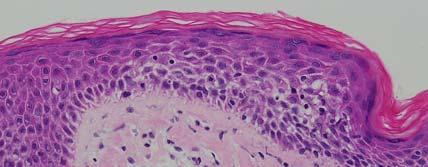 perivascular infiltrate (sometimes with eosinophils) Subacute: Usually areas of