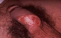 extragenital NF which is usually caused by Group A strep Deep vessel thrombosis and