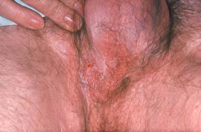 Bowen s disease Bowen s disease Carcinoma of the Vulva Two