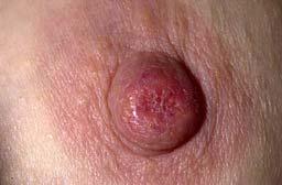 Paget s Disease (mammary and extramammary) (1874) Sir James Paget described an