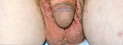 - internal malignancy (rectum, cervix, prostate, bladder,