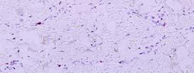 positive Lymphangiosarcoma arising in the