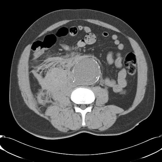 Rupture of abdominal aortic aneurysm A retroperitoneal hematoma adjacent to an