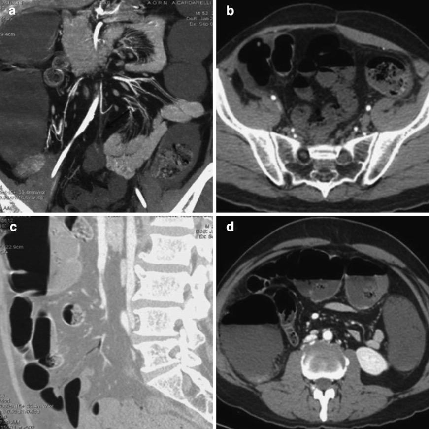 CT Collapsed small bowel with