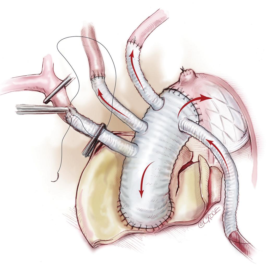 The 4-branched graft is Figure 8 Innominate artery reconstruction.