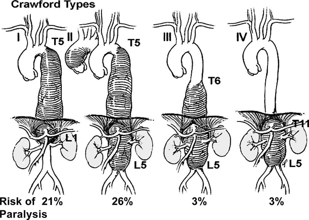 Journal of Clinical Neurophysiology Volume 24, Number 4, August 2007 Evoked Potentials in Thoraco-abdominal Surgery FIGURE 1. Crawford classification of thoraco-abdominal aortic aneurysm.