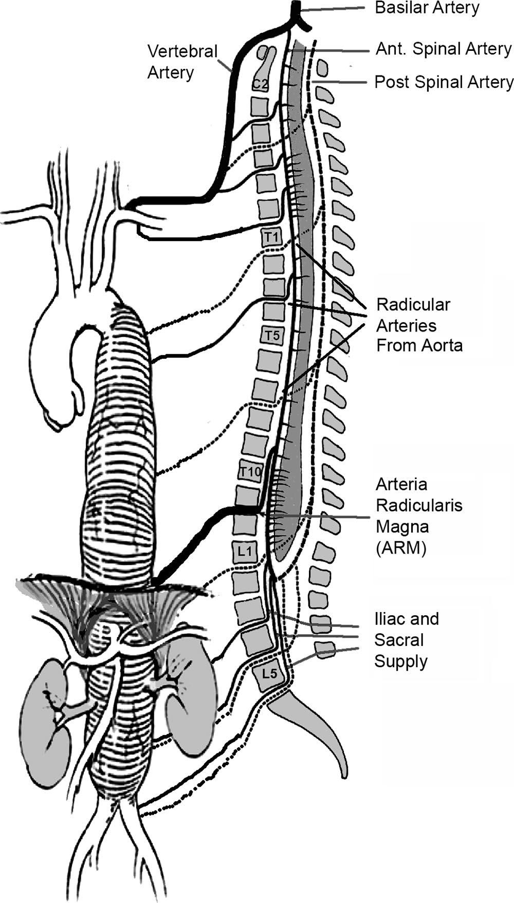 The aneurysm does not extend into the abdomen and may not involve the Arteria radicularis magna (ARM).
