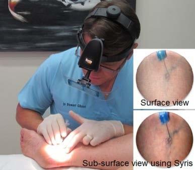 USES FOR SYREASE The SyrEase device can be used with liquid sclerotherapy,